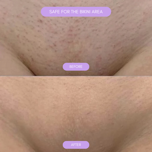 Hair Removal Device for Silky Smooth Skin